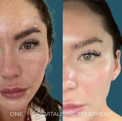 [5 bottle 5 use ] Spicules Bio microneedling 60% Natural Algae Peeling powder