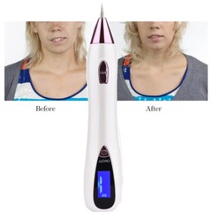Electric Laser Cauterizer Skin Tag Remover Warts Eliminator LCD Plasma Pen Kit
