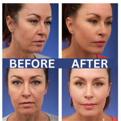 Hyaluronic Acid , Apple Stem-Cell + Matrixyl 3000 Peptide AntiAging Serum – 4 oz