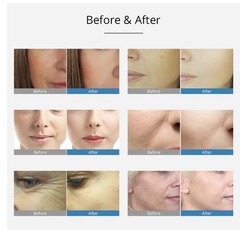 EMS Meso Injector No Needle RF Mesotherapy Gun Skin Wrinkle Removal Rejuvenation