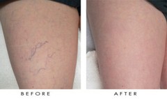 Lux Vitamin K Cream – Eliminate Spider Varicose Veins Scars Rosacea Capillaries