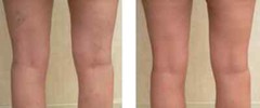 Lux Vitamin K Cream – Eliminate Spider Varicose Veins Scars Rosacea Capillaries