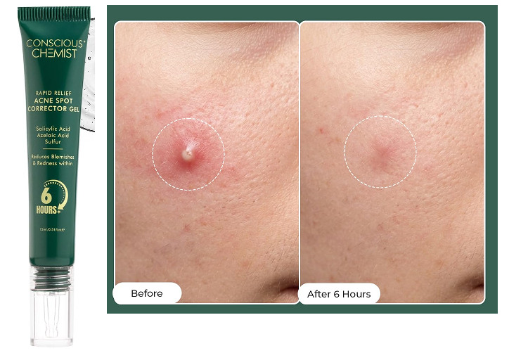 Conscious Chemist Relief Acne Spot Corrector Gel with 2% Salicylic Acid 15gm