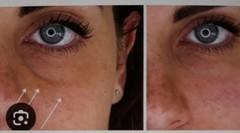 PDOs ThreAs*/EYE 30G 25mm/20pcs/Lifting Face/Wrinkle Face