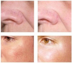 Lux Vitamin K Cream – Eliminate Spider Varicose Veins Scars Rosacea Capillaries