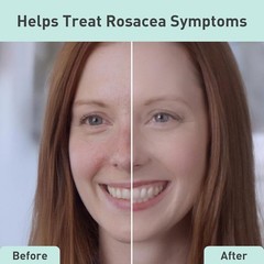 Travel-Friendly Rosacare Hydrogel – 2 Fl Oz Face Moisturizer for Rosacea Relief