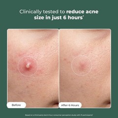 CONSCIOUS CHEMIST Rapid Relief 15g in 6 HOUR Pimples, Acne Spot Corrector Gel