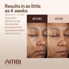 Ambi Even & Clear Advanced Fade Cream, Hydroquinone-free, Hyperpigmentation Trea