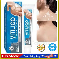 Vitiligo Treatment, Vitiligo Cream Improve Skin Pigmentation & Reduces White …