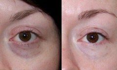 Lux Vitamin K Cream – Eliminate Spider Varicose Veins Scars Rosacea Capillaries