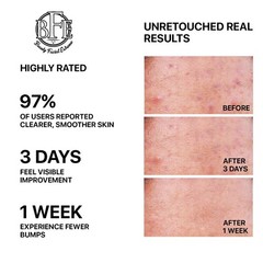 Anti-Acne Buttocks & Thigh Treatment-Clears Away Acne, Pimples, and Ingrown Hair