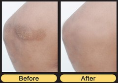 Lux Vitamin K Cream – Eliminate Spider Varicose Veins Scars Rosacea Capillaries