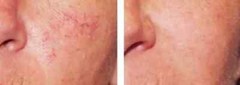 Lux Vitamin K Cream – Eliminate Spider Varicose Veins Scars Rosacea Capillaries