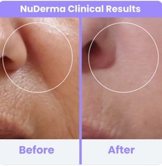 NuDerma Clinical Skin Therapy Wand w/ 6 FUSION Applicators