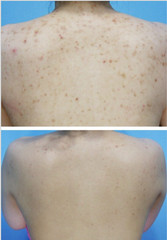 [5 bottle 5 use ] Spicules Bio microneedling 60% Natural Algae Peeling powder