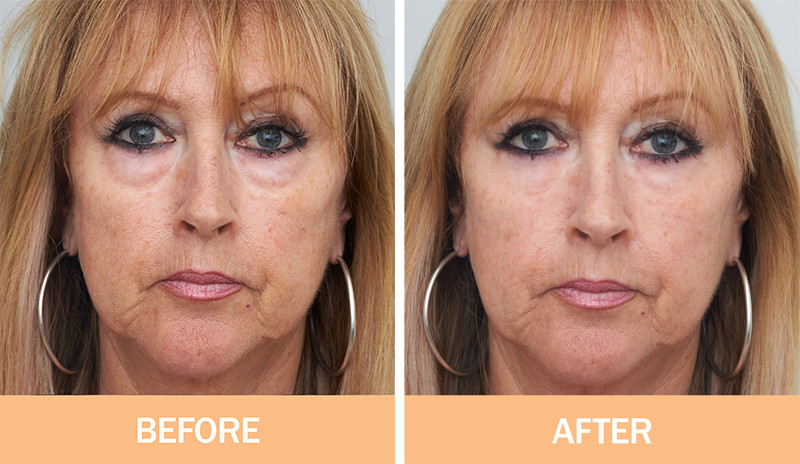 No.1 Instant Wrinkle Serum- 5 STAR REVIEWS- IT WORKS A++++- REPEAT CUSTOMERS