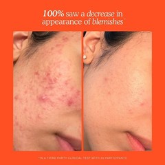Authentic Tower 28 Daily Hypochlorous Acid Spray for Breakouts Redness,3 SIZES